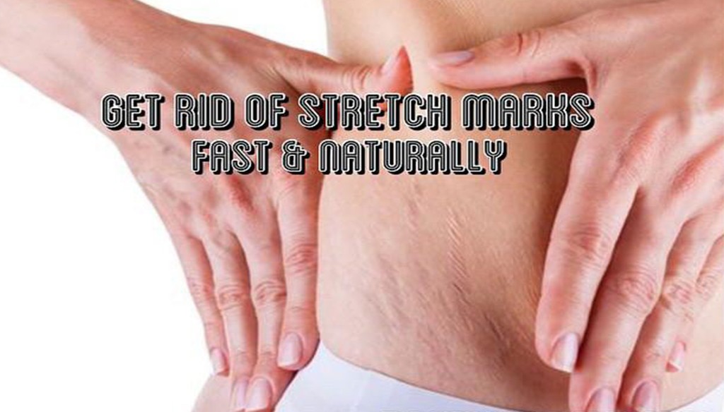 Get Rid Of White Stretch Marks Naturally Get Rid Of White Stretch Marks Naturally